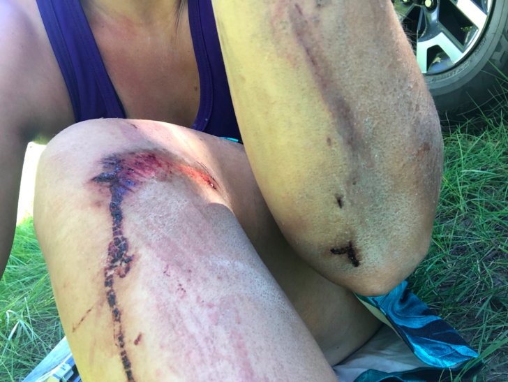 一个女人膝盖和肘部擦伤的特写。